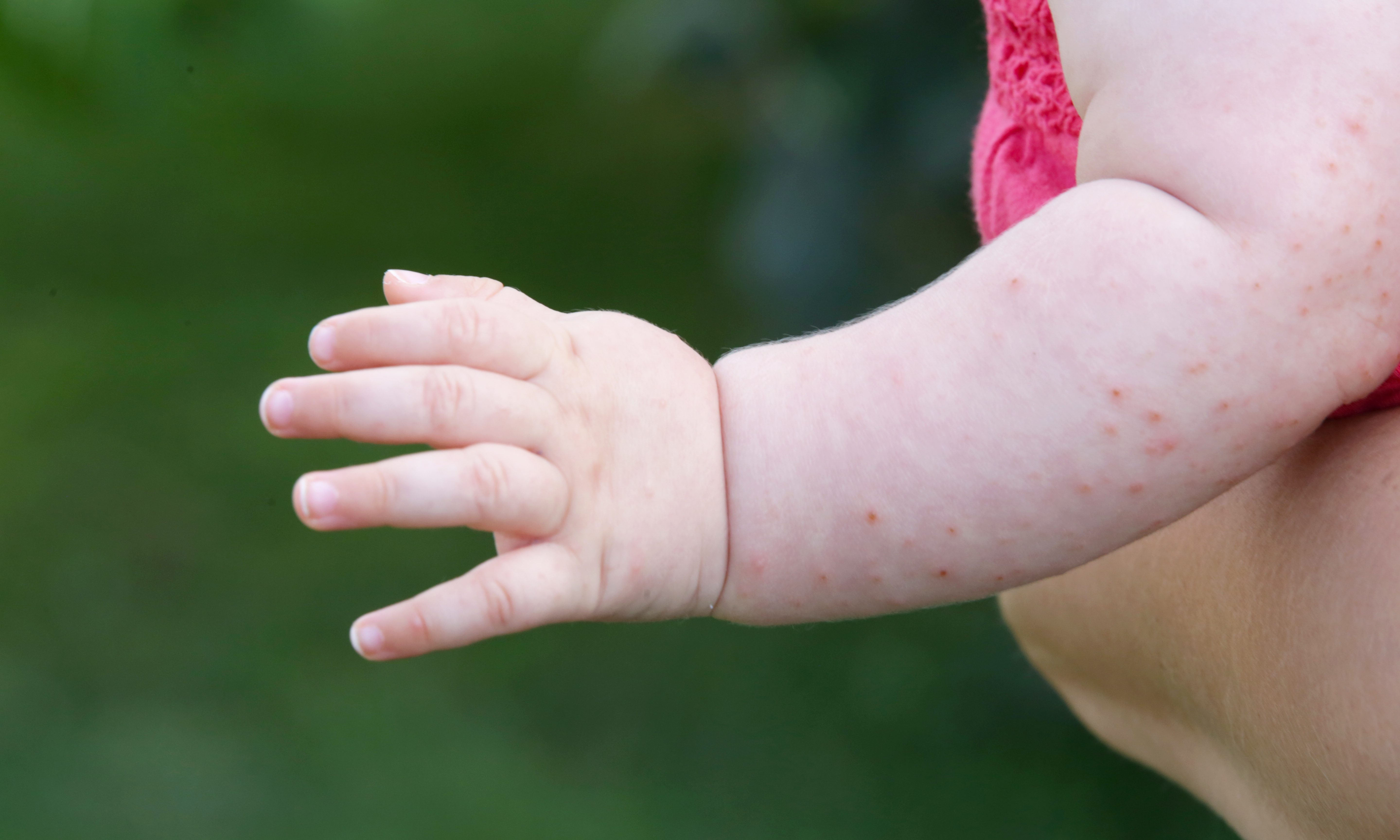 First measles case reported in Alabama